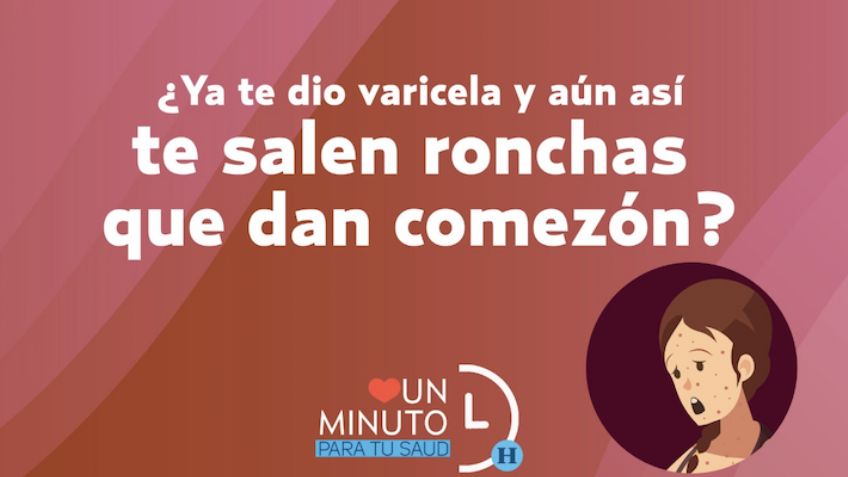 ¿Ya te dio varicela y aún sí te salen ronchas que dan comezón?