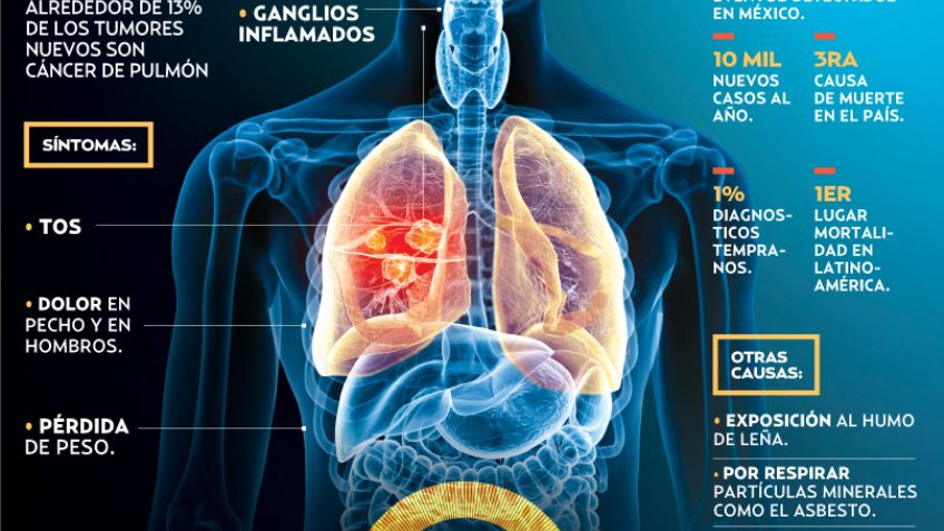 Cáncer de pulmón: Enfermedad agresiva  y mortal