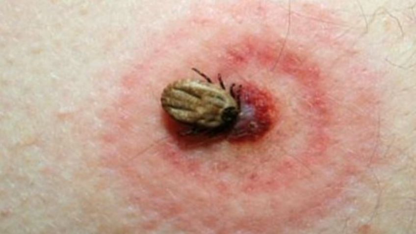 Qué es la enfermedad de Lyme: causas, síntomas y tratamiento