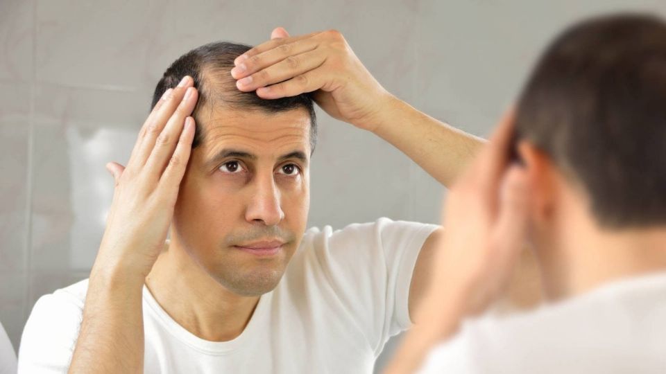 Caída de pelo, imagen ilustrativa. Foto: Especial