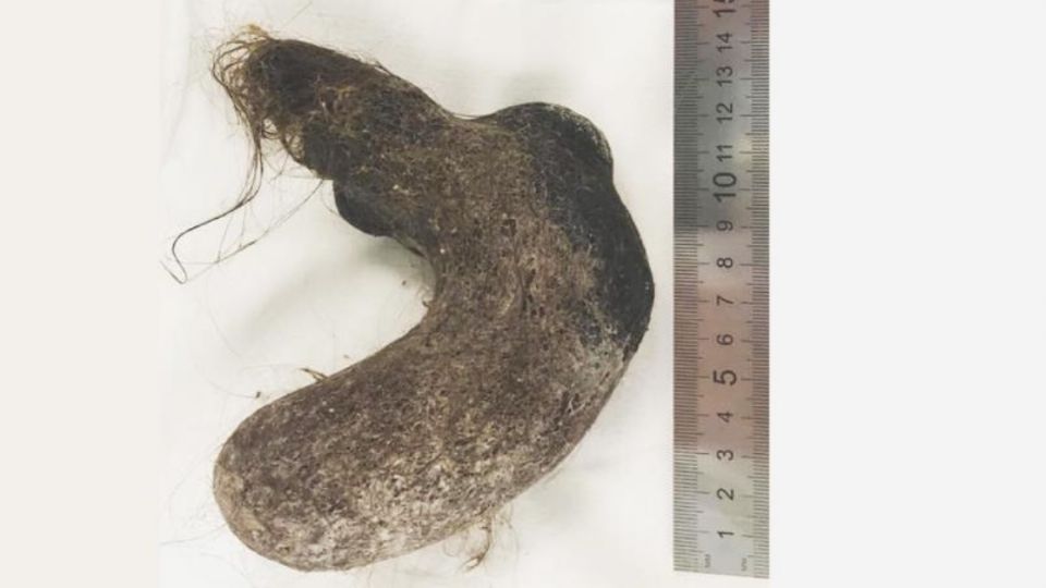 La niña tenía una especie de tumor hecha de pelo. Foto: Especial