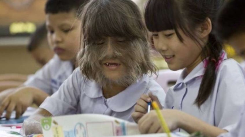 FOTOS: La niña más peluda del mundo padece Síndrome del Hombre Lobo