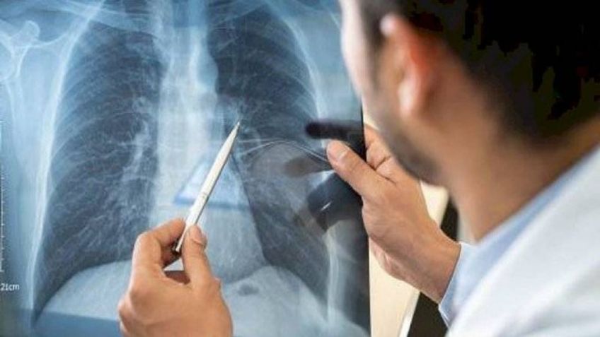 ¡Peor que el tabaco! Pulmones de pacientes Covid-19 resultan más daños que los de fumadores