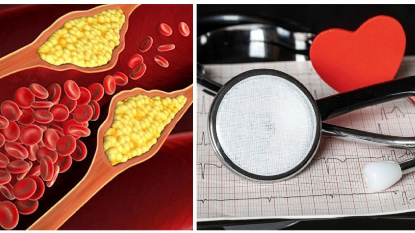 Colesterol arriba de 500: ¿Qué le pasa a mi cuerpo con ese nivel y cómo bajarlo?