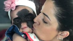 "¡Ya soy una princesa!": Niña de 2 años celebra que ya no tiene una "marca de Batman" en la cara