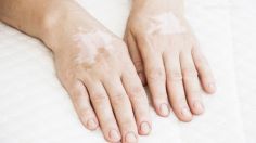 Niegan servicio a joven de Saltillo sólo por padecer vitiligo; el caso se viraliza