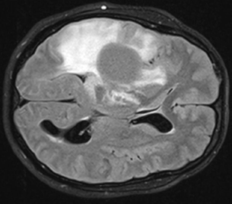 Imagen de resonancia magnética de glioma difuso.