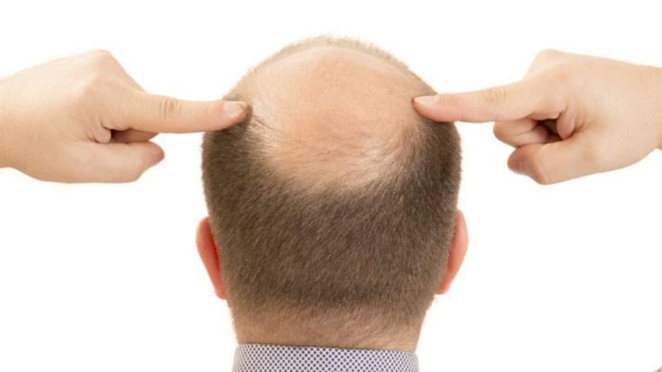 Personas con alopecia son más propensas al Covid-19. Foto: Especial.