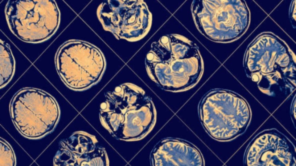 Estados Unidos aprueba medicamento para tratar Alzheimer. Foto: iStock