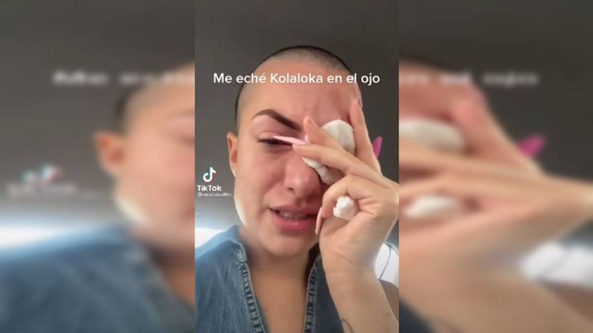 ¿Qué daños causa la Kola-Loka en la piel? Una tiktoker se puso pegamento en los ojos