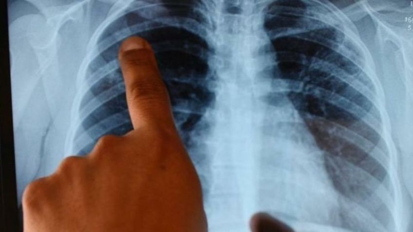 FOTO: Así se ven los pulmones de un niño con posible contagio de Covid-19