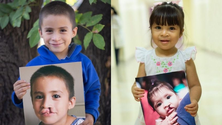 Organización recupera sonrisas de niños que padecen labio y paladar hendido