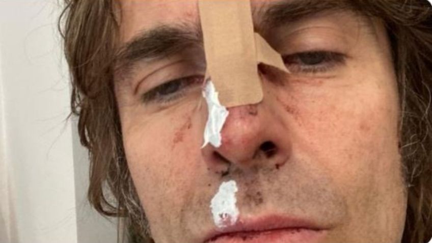 Liam Gallagher aparece herido en una foto tras "caer de un helicóptero"