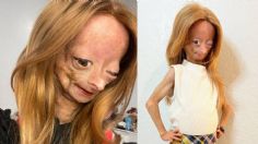 Quién era Adalia Rose, la “Benjamin Button” de la vida real que murió de envejecimiento prematuro