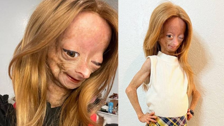 Quién era Adalia Rose, la “Benjamin Button” de la vida real que murió de envejecimiento prematuro