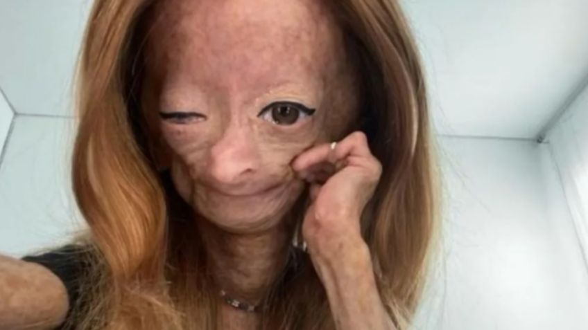 Muere Adalia Rose Williams a los 15 años, youtuber que vivía con progeria