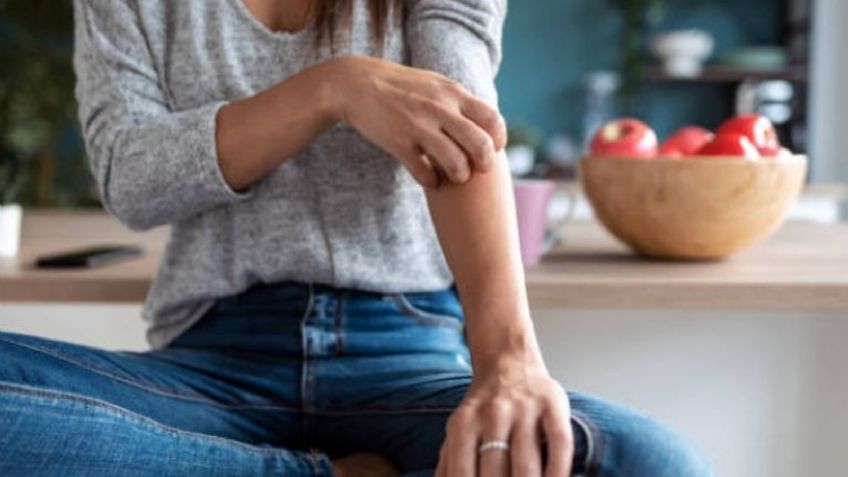 Psoriasis, una enfermedad sin cura que estigmatiza a los pacientes por su apariencia