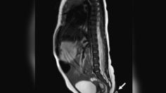 El extraño caso de un bebé que nació con una "cola" de casi 6 centímetros