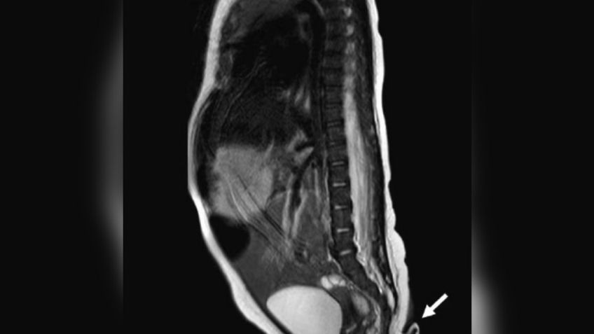 El extraño caso de un bebé que nació con una "cola" de casi 6 centímetros
