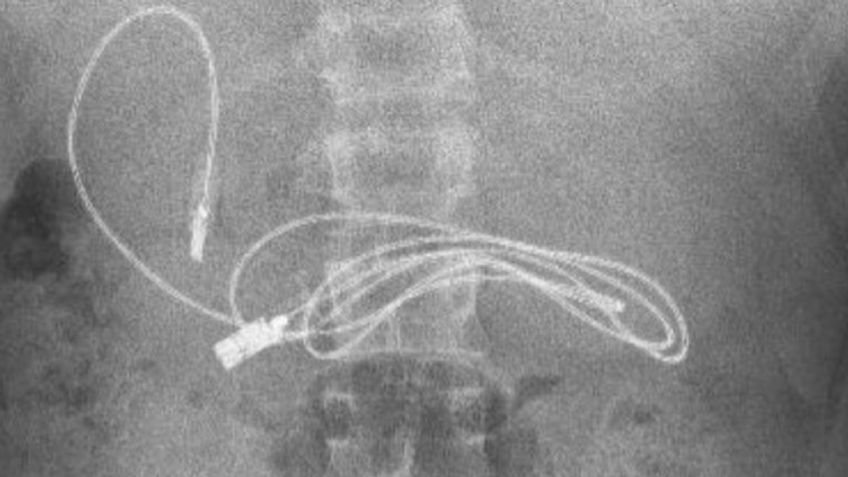 Llegó a urgencias por un intenso dolor estomacal: los médicos le encontraron un usb en el colon