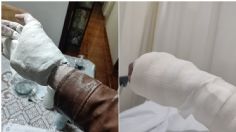 Colocan yeso a un hombre con chamarra y ya no pudo quitársela | FOTO