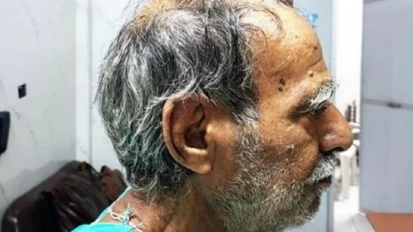 Extraño "cuerno del diablo" creció sobre la cabeza de un hombre en la India