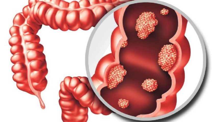 3 hábitos que provocan cáncer de colon de silenciosa manera