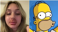 Joven se gana el apodo de “Homero Simpson” tras someterse a procedimiento estético de labios | VIDEO