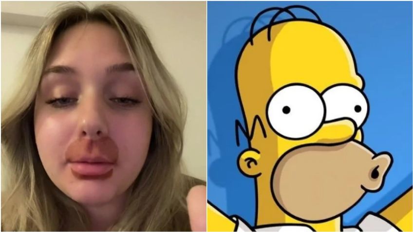 Joven se gana el apodo de “Homero Simpson” tras someterse a procedimiento estético de labios | VIDEO