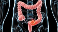 Cáncer de colon: ¿Cuáles son los síntomas de esta enfermedad y que tan grave es?