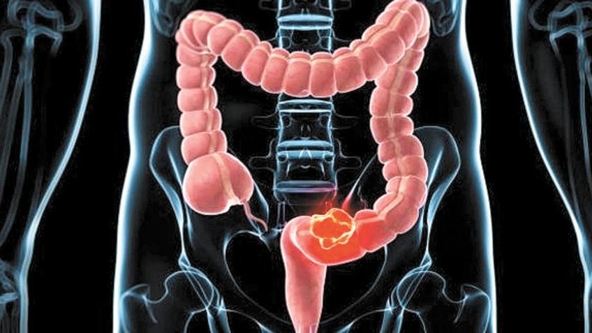 Cáncer de colon: ¿Cuáles son los síntomas de esta enfermedad y que tan grave es?