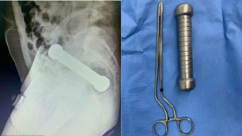 Tenía un fuerte dolor abdominal, pero los médicos encontraron una mancuerna de 2 kilos en el recto