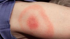 ¿Qué es la enfermedad de Lyme que padece Thalía? Estos son los síntomas y consecuencias