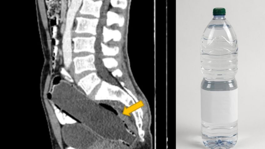 Creyó que estaba estreñido, pero los médicos encontraron una botella de agua atorada en su intestino grueso