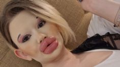 "La Barbie humana" se aplica 30 inyecciones en los labios de ácido hialurónico: este fue el resultado