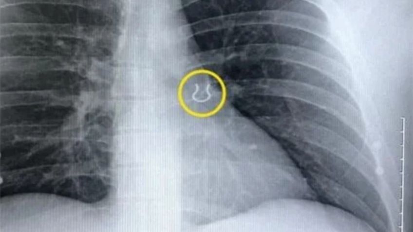 Un hombre perdió su piercing: lo encontró 5 años después en sus pulmones tras pensar que tenía neumonía