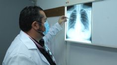 El ISSSTE implementa estrategia para mejorar atención de pacientes con fibrosis quística