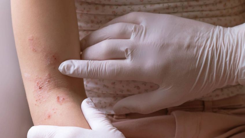 Dermatitis atópica: no sólo daña la piel, también la salud mental