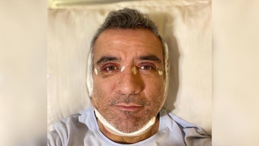 ¡Qué guapo! Así luce Héctor Sandarti a 17 días de su cirugía estética