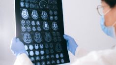 ¿Qué es el infarto cerebral y cómo prevenirlo? Es la segunda causa de discapacidad en México