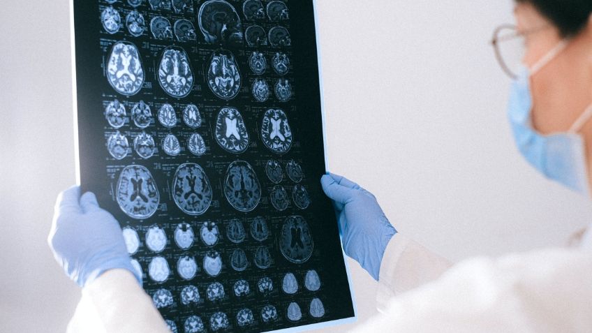 ¿Qué es el infarto cerebral y cómo prevenirlo? Es la segunda causa de discapacidad en México