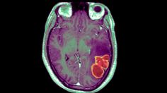 Emergencia de salud: médicos alertan por una fuerte infección cerebral en niños de EU