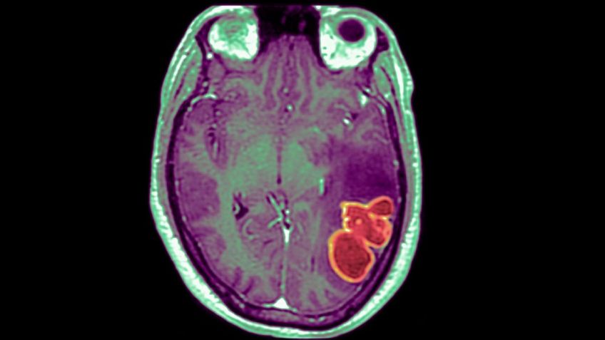 Emergencia de salud: médicos alertan por una fuerte infección cerebral en niños de EU