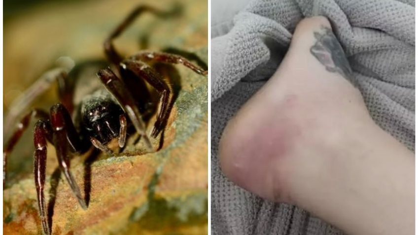 Una mujer fue picada por una araña, su vida corrió riesgo y al final perdió una pierna