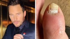 ¿Tienes hongos en las uñas como Chris Pratt?, así puedes eliminarlos con bicarbonato