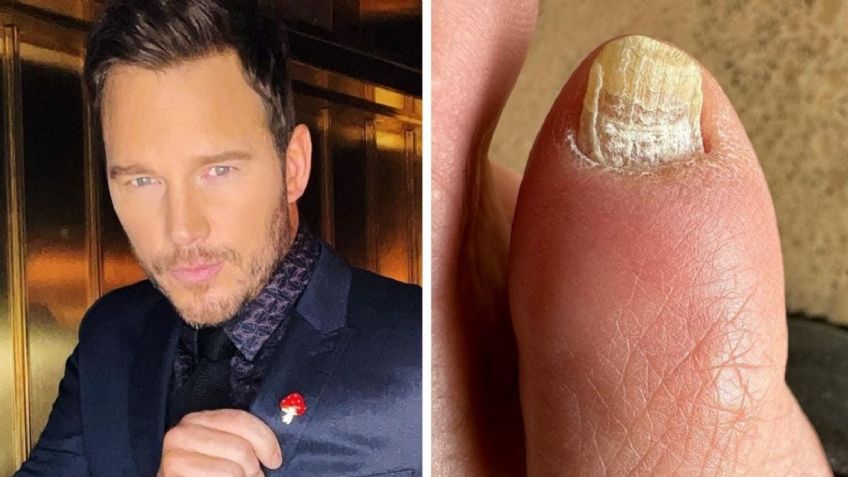 ¿Tienes hongos en las uñas como Chris Pratt?, así puedes eliminarlos con bicarbonato