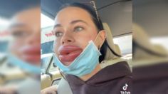 VIDEO: Influencer se rellenó los labios con ácido hialurónico y terminó desfigurada