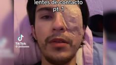 Joven relata en TikTok cómo perdió un ojo por usar lentes de contacto: "creí que era conjuntivitis"