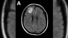 Fue al doctor por dolor de estómago, pero tenía un peligroso parásito de 8 centímetros en el cerebro