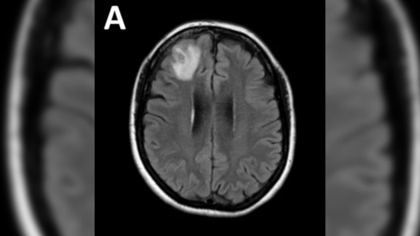 Fue al doctor por dolor de estómago, pero tenía un peligroso parásito de 8 centímetros en el cerebro